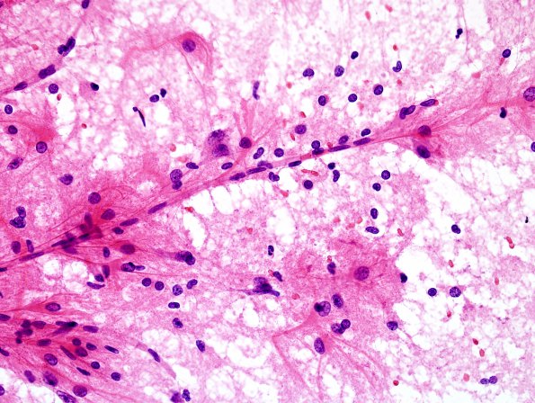 1A3 Astrocytic proliferation (Case 4) smear H&E 3