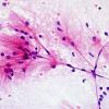 1A4 Astrocytic proliferation (Case 4) smear H&E 4