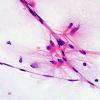 1A5 Astrocytic proliferation (Case 4) smear H&E 6