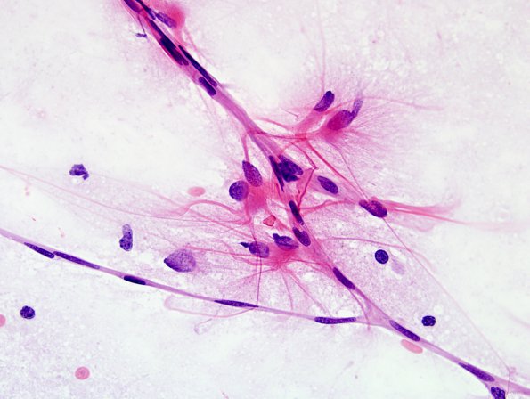 1A5 Astrocytic proliferation (Case 4) smear H&E 6