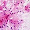 1A6 Astrocytosis (Case 4) smear H&E 7