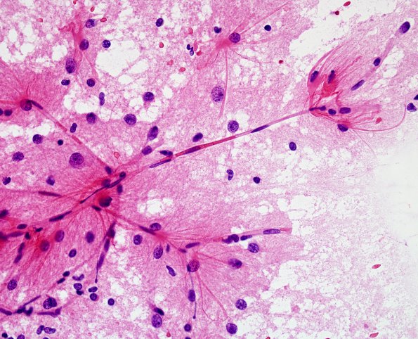 1A6 Astrocytosis (Case 4) smear H&E 7