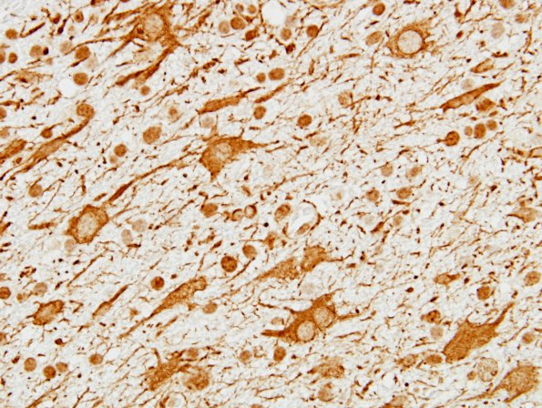 2 Astrocytosis, Reactive kissing (Case 14) GFAP