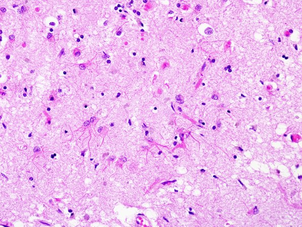 3 Astrocytosis, (Case 6) H&E 1