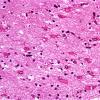 4 Astrocytosis, Reactive, Gemistocyte transition with fibrillary Astrocytes H&E 3 (Case 13)