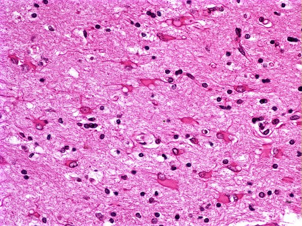 4 Astrocytosis, Reactive, Gemistocyte transition with fibrillary Astrocytes H&E 3 (Case 13)