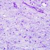 5 Astrocytosis, ALS, (Case 19) Holtzer stain 40X