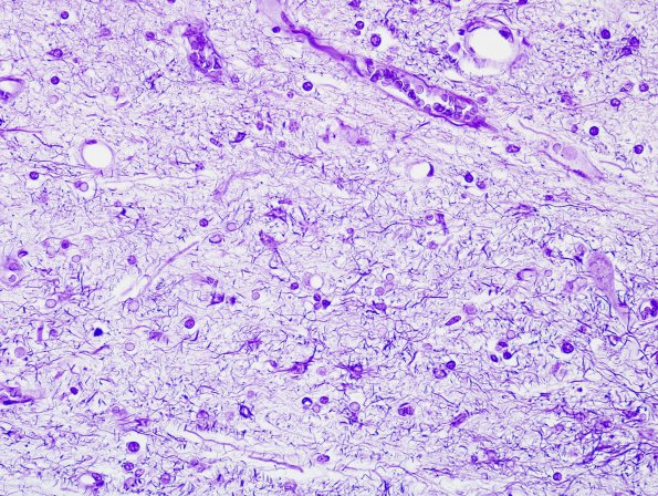 5 Astrocytosis, ALS, (Case 19) Holtzer stain 40X