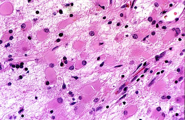 6A1 Astrocytosis, Reactive, Gemistocytes H&E 1