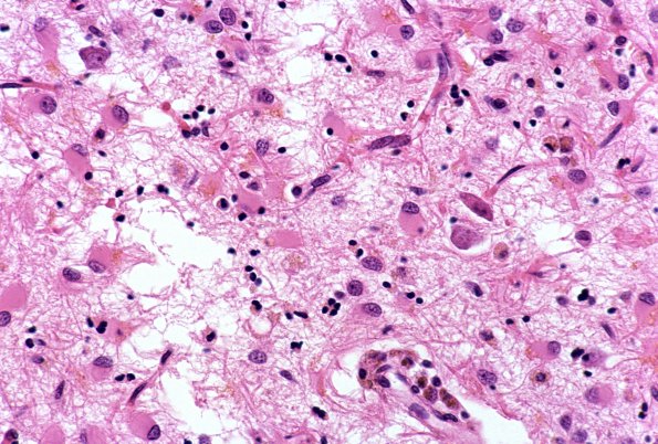 6A2 Astrocytosis, Reactive, Gemistocytes H&E 2