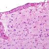 7 Astrocytosis, gemistocytes (ZOO Bantam Hen) H&E 1A