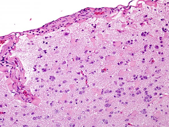 7 Astrocytosis, gemistocytes (ZOO Bantam Hen) H&E 1A