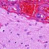 8A1 Astrocytosis, subpial (Case 18) 2