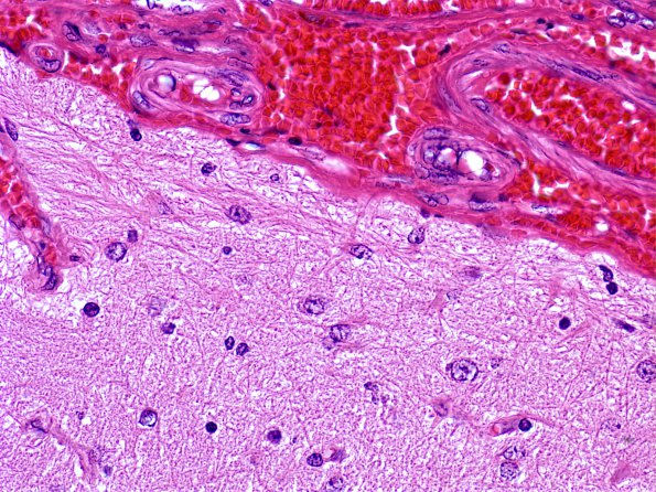 8A1 Astrocytosis, subpial (Case 18) 2