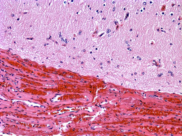 8A2 Astrocytosis, subpial, (Case 18) 1