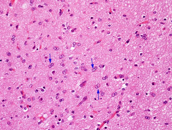 9 Astrocytosis, kissing, mitochondrial mutations (Case 23) cortex H&E