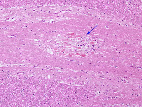 1A1 Axon, Spheroids, pontine microinfarct (Case 2) H&E 1