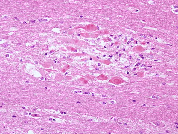 1A2 Axon, Spheroids, pontine microinfarct (Case 2) H&E 2