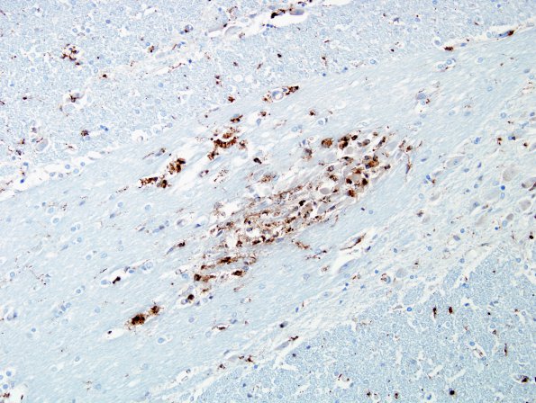 1B1 Axon, Spheroids, pontine microinfarct (Case 2) CD68