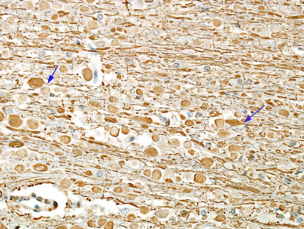 1B3 Axon, Spheroids, pontine microinfarct (Case 2) NF 3