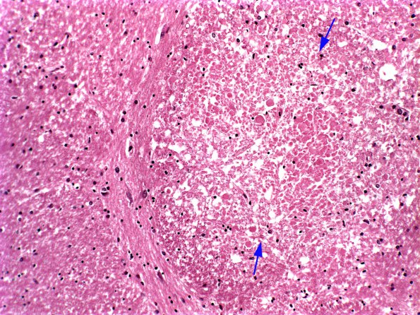 2A1 Axon, spheroids, Pons (Case 10) 2