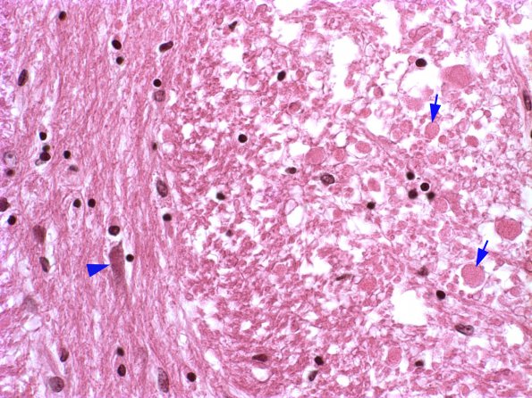 2A2 Axon, Spheroids, Pons (Case 10) 1