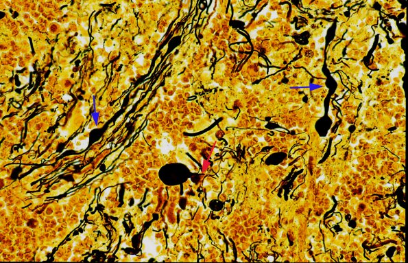 3 Axon, Spheroids, Pons, Hemorrhage Biels