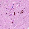 7 Axon, spheroid, granular SNigra (Case 11) H&E