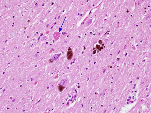 7 Axon, spheroid, granular SNigra (Case 11) H&E