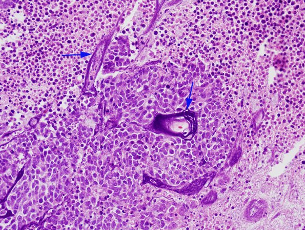 1A1 Azzopardi Phenomenon (Case 1) H&E 1