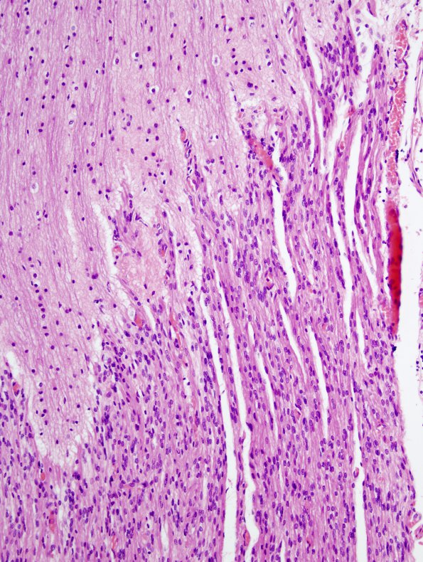 2A3 Brainstem, neonate, V Nerve (Case 2)  H&E 2