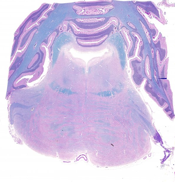 2B1 Brainstem, neonate, V Nerve (Case 2)  LFB-PAS 1