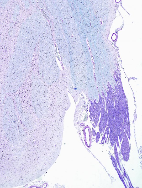 2B2 Brainstem, neonate, V Nerve (Case 2)  LFB-PAS 2A