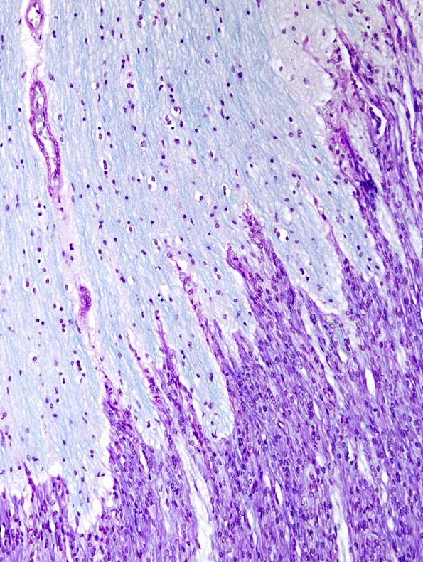 2B3 Brainstem, neonate, V Nerve (Case 2)  LFB-PAS 3A