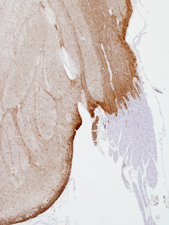 2C2 Brainstem, neonate, V Nerve (Case 2)  GFAP 3