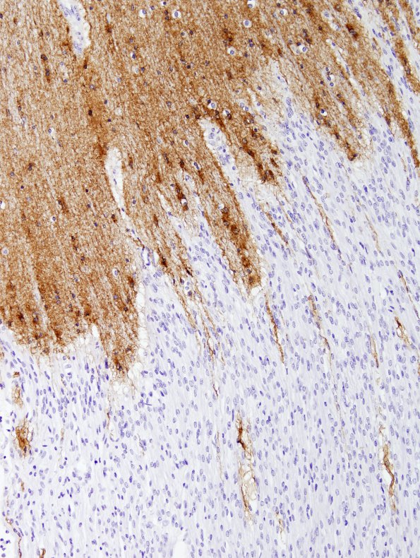 2C3 Brainstem, neonate, V Nerve (Case 2)  GFAP 2