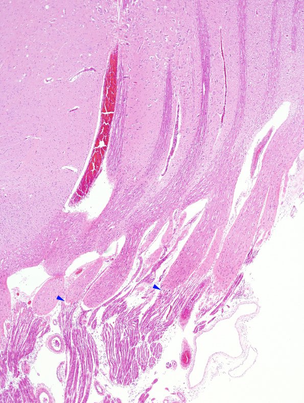 3A1 Obersteiner-Redlich Zone (Glial domes, Case 3) N6 H&E 2 copy