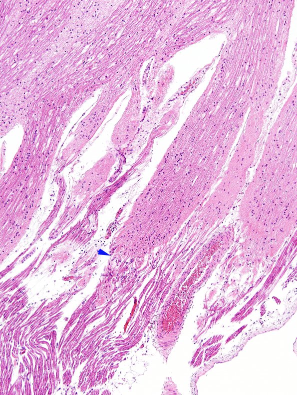 3A2 Obersteiner-Redlich Zone (Glial domes, Case 3) N6 H&E copy