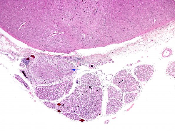 4B1 Root entry zone (Obersteiner-Redlich zone, Case 4) H&E 4XA