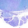 4B2 Root entry zone (Obersteiner-Redlich zone, Case 4) LFB-PAS 4Xa