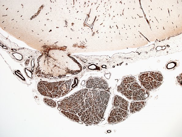 4B4 Root entry zone (Obersteiner-Redlich zone, Case 4) Coll IV 4XA