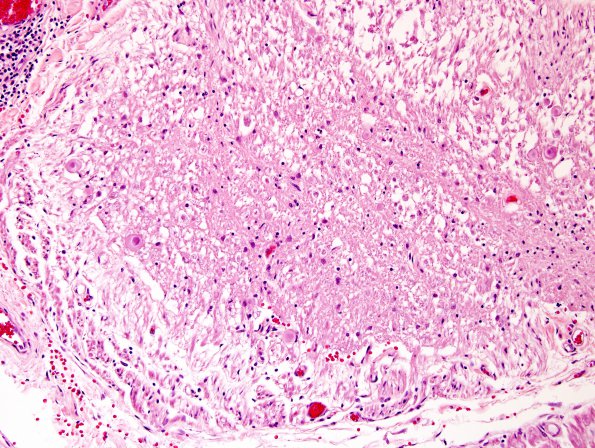 4C1 Root entry zone (Obersteiner-Redlich zone, Case 4) H&E 20XA