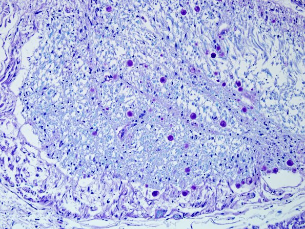 4C2 Root entry zone (Obersteiner-Redlich zone, Case 4) LFB-PAS 20XA