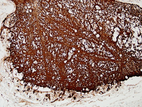 4C3 Root entry zone (Obersteiner-Redlich zone, Case 4) GFAP 20XA