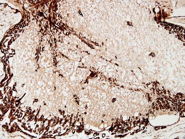 4C4 Root entry zone (Obersteiner-Redlich zone, Case 4) Coll IV 20XA