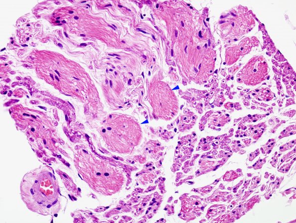 5A1 Obersteiner-Redlich Zone XII nerve (Case 5) H&E 1 copy