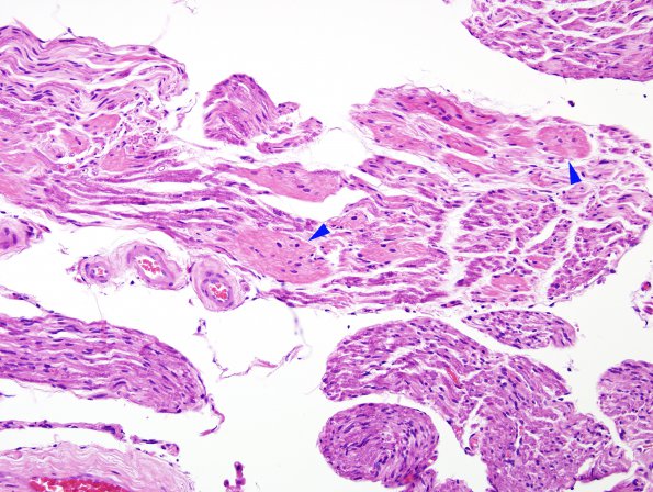 5A2 Obersteiner-Redlich Zone XII nerve (Case 5) H&E 2 copy