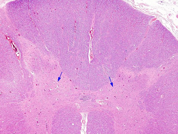 10A1 Central Chromatolysis Mimic (Clarke's column, Case 5) H&E 1