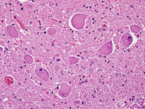 10A2 Central Chromatolysis Mimic (Clarke's column, Case 5) H&E 2.