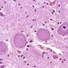 10A3 Central Chromatolysis Mimic (Clarke's column, Case 5) H&E 2